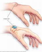 Image result for Ganglion Cyst in Capitate