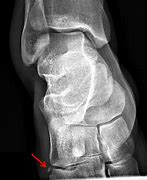 Image result for Avulsion Fracture