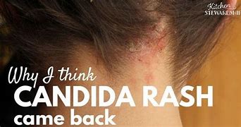 Image result for Candida Neck Rash