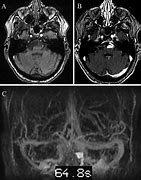 Image result for Aneurysm in MRI