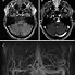 Image result for Aneurysm in MRI