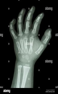 Image result for Child's Hand X-ray