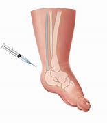 Image result for Heel Cord Tenotomy