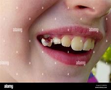 Image result for Loose Tooth