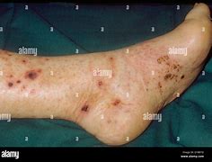 Image result for Vasculitis Leg Ulcers