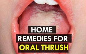 Image result for Candida Throat Infection