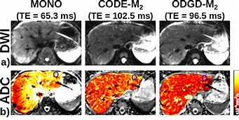 Image result for Diffusion MRI