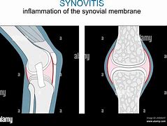 Image result for Inflammed Synovial Tissue