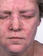 Image result for Vasculitis On Face