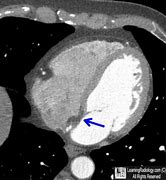 Image result for Interatrial Septum Lipomatous Hypertrophy Echo