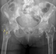 Image result for Osseous Metastatic Disease