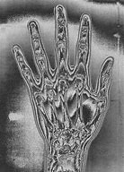 Image result for Bone Age Hand X-ray