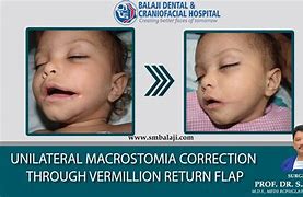 Image result for Microstomia