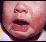 Image result for Baby Eczema Hands