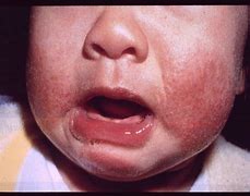 Image result for Eczema On Baby Arm