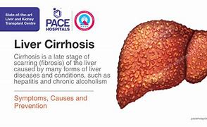 Image result for Early Symptoms Cirrhosis Liver