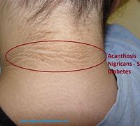 Image result for Diabetes Skin Darkening