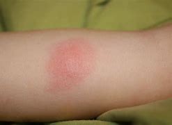 Image result for Spider Bite with Red Circle