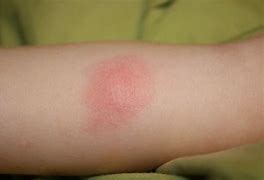 Image result for Blood with Circle Bite