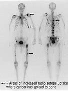 Image result for CT Scan Bone Cancer