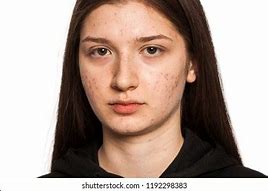 Image result for Pimple Face Lady