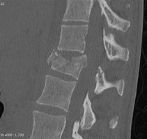 Image result for Lumbar Compression Burst Fractures