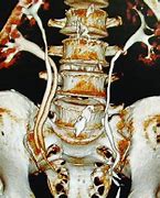 Image result for Double Ureter Radiology