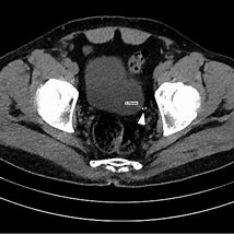 Image result for Long Tunnel Ureter