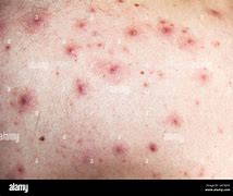 Image result for Pustules Back