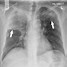 Image result for Chest X-ray of TB