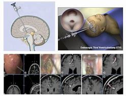 Image result for Brain Shunts Hydrocephalus