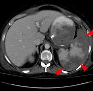 Image result for Spleen Metastasis