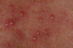 Image result for Pustule Rashes