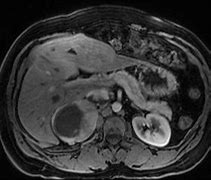 Image result for Large Pheochromocytoma CT