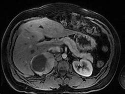 Image result for Pheochromocytoma On CT Scan