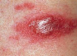 Image result for Red Flat Skin Lesion