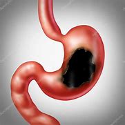 Image result for Ulcer Stomach Actual Photo