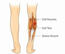 Image result for Tear in Calf Muscle