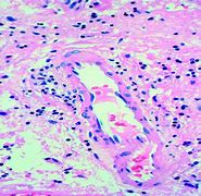 Image result for Mycobacterium Avium Infection