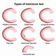 Image result for Meniscal Tear Treatments