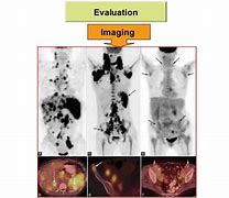 Image result for Hodgkin Lymphoma PET/CT