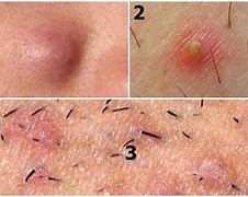 Image result for Ingrown Hair Blackheads