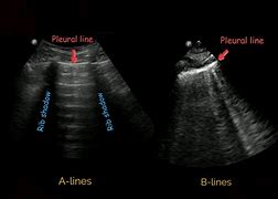 Image result for Lung Ultrasound B Lines Pulmonary Edema