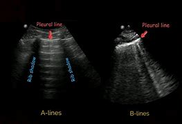 Image result for Pulmonary Regurg Ultrasound Flame