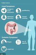 Image result for Colon Cancer Early Symptoms