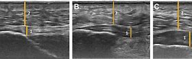 Image result for Plantar Fascia Ultrasound