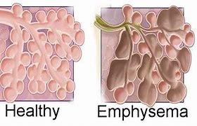 Image result for Emphysema