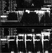 Image result for Left Ventricular Outflow Tract Stroke Volume