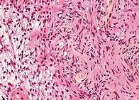 Image result for Vestibular Schwannoma Gross Pathology