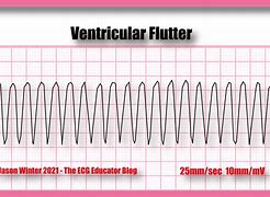 Image result for Ventricular Flutter and Fibrillation